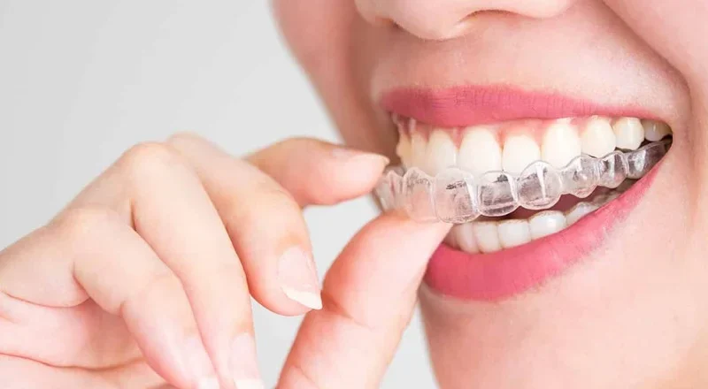 The Ultimate Guide to Invisalign for Teens: What You Need to Know